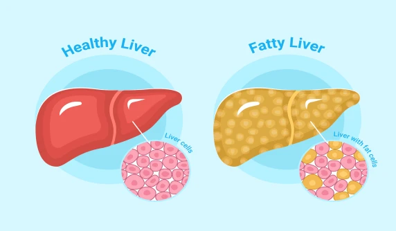 The Unexpected Consequences of a Fatty Liver