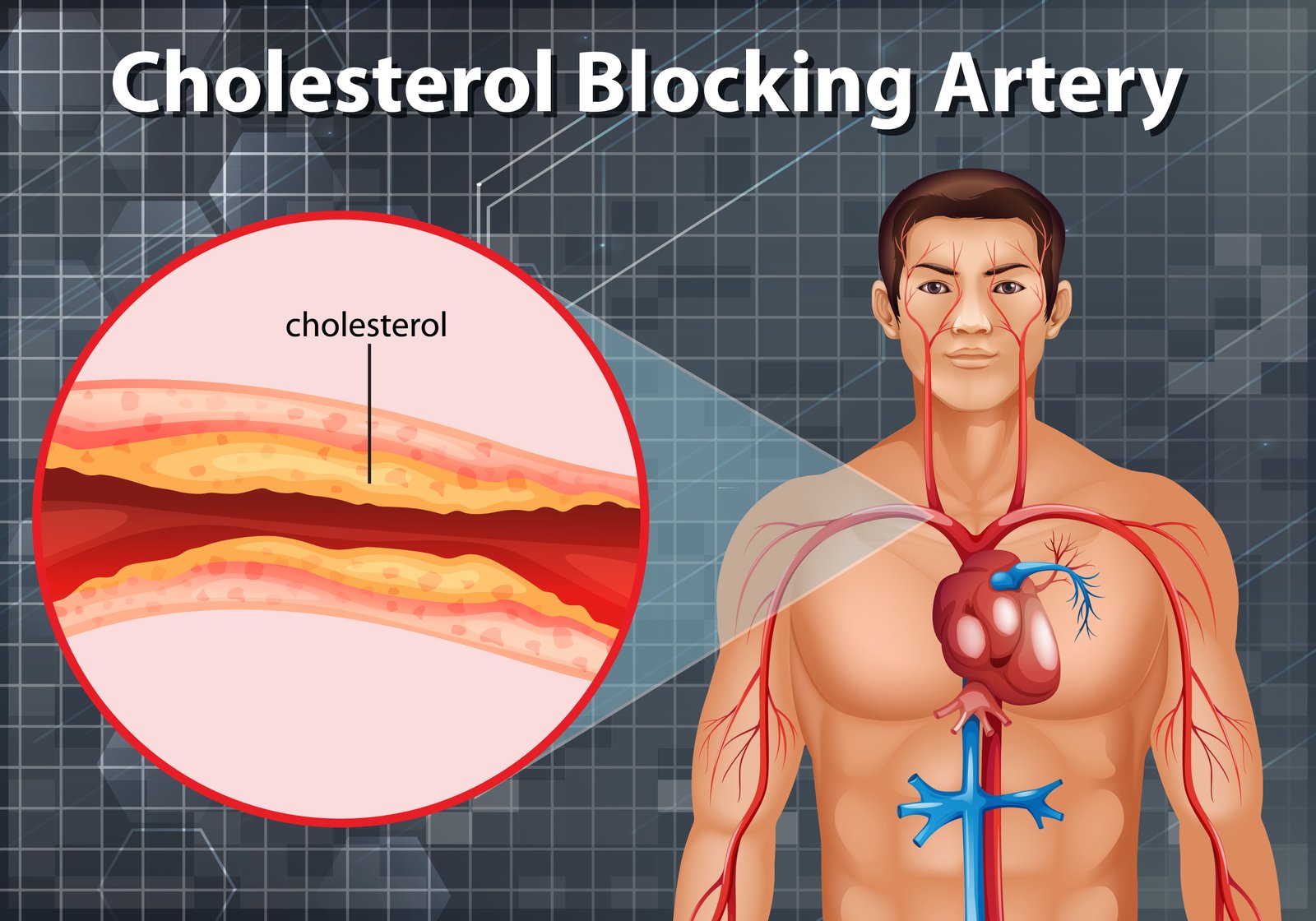 How To Clean Your Arteries