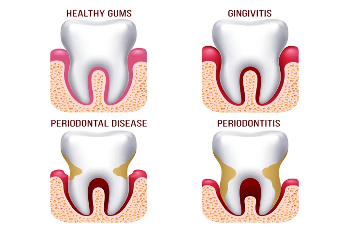 You lose more bone and tissue surrounding your teeth as periodontal disease worsens. Numerous issues, such as tooth loss and gum recession, may result from this.
